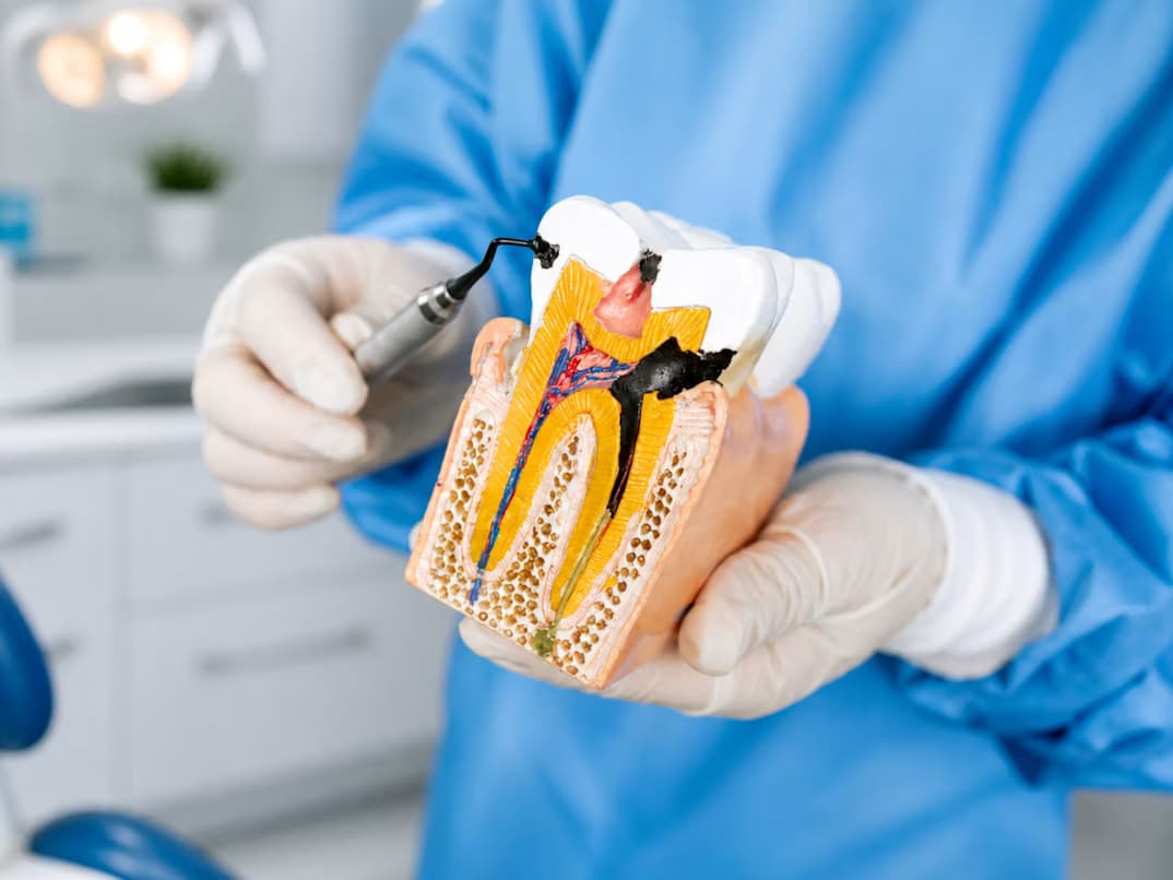 Odontólogo tratando una caries dental a un paciente en el consultorio