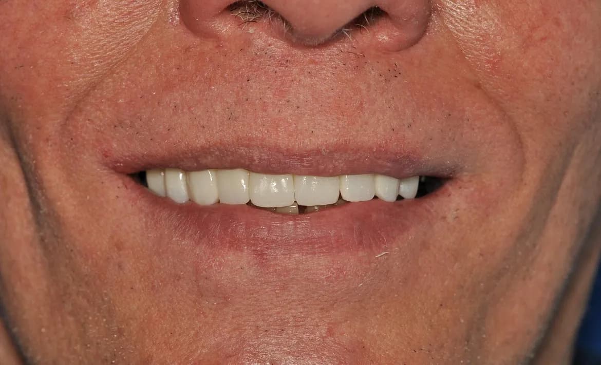Paciente sonriendo tras la rehabilitación completa con coronas cerámicas