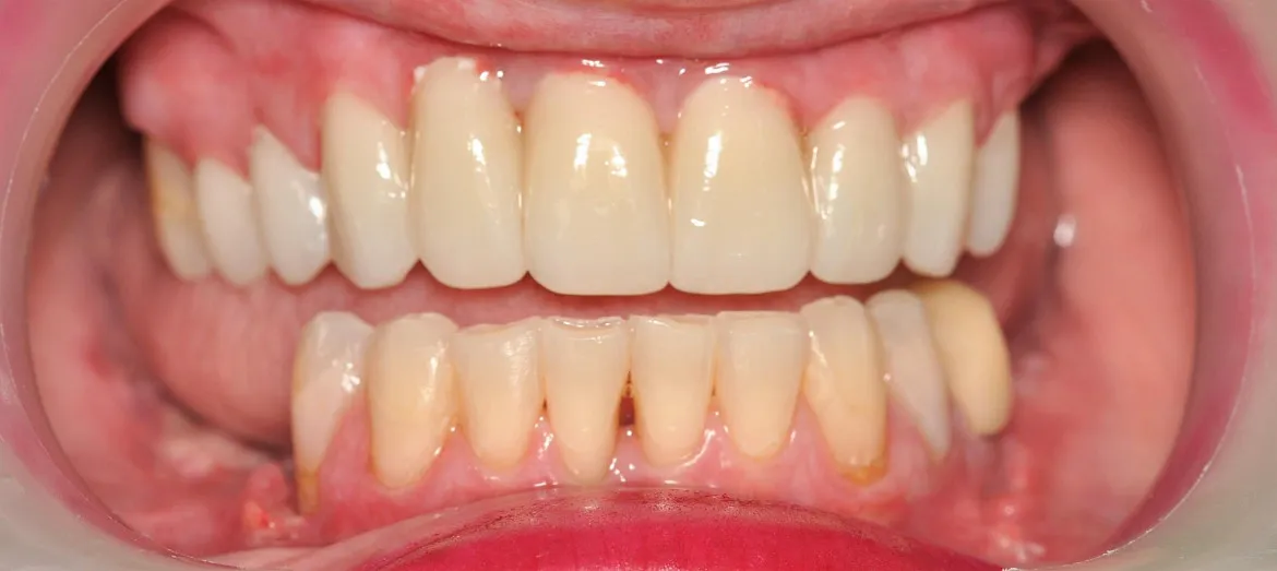 Arcada superior rehabilitada con coronas cerámicas frente a la dentición inferior natural