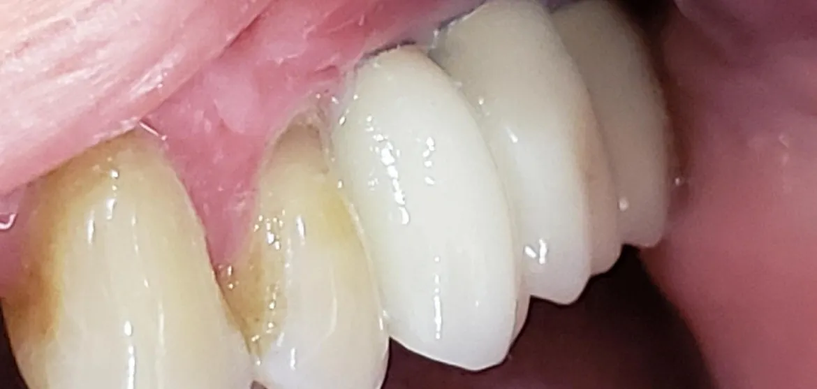 Coronas cerámicas sobre implantes en sector lateral posterior
