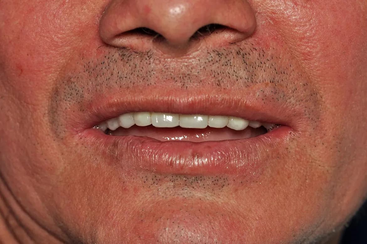 Sonrisa natural del paciente con prótesis cerámica sobre implantes