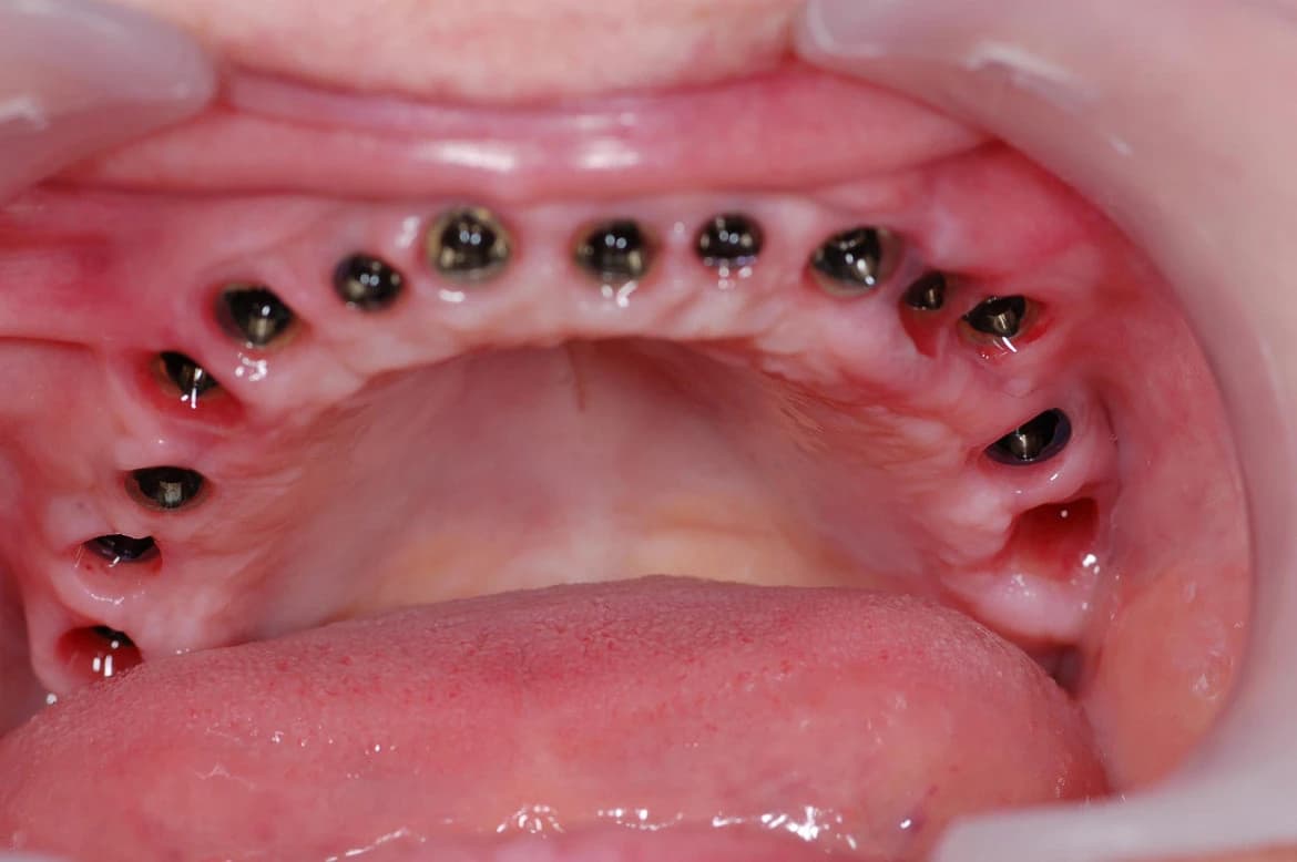 Vista oclusal de arcada superior con implantes colocados antes de la fase protésica en Ciudad Jardín Lomas del Palomar