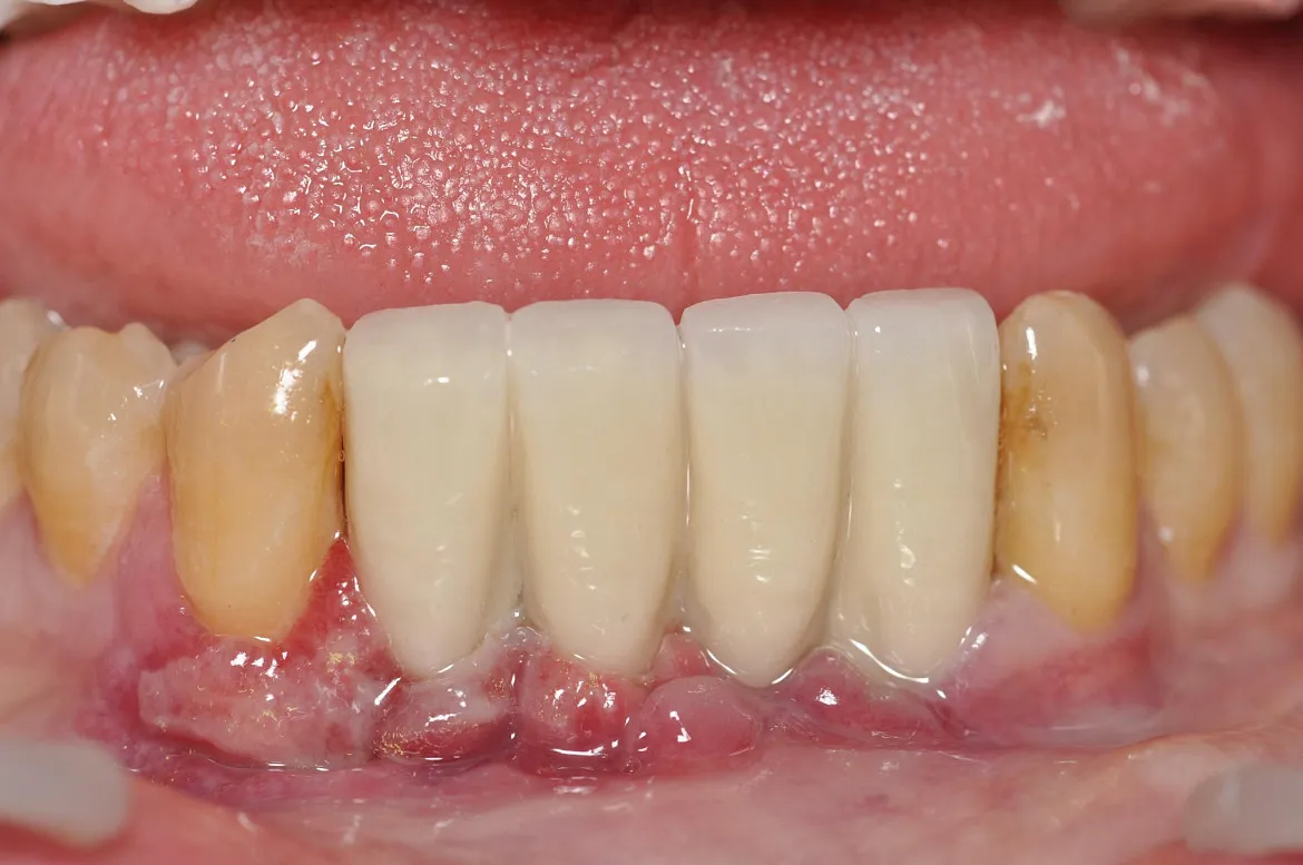 Coronas cerámicas sobre implantes en sector anterior inferior, resultado final