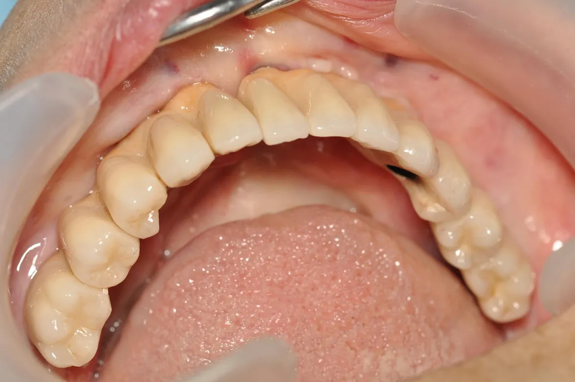 Estructura protésica cerámica sobre implantes en arcada superior