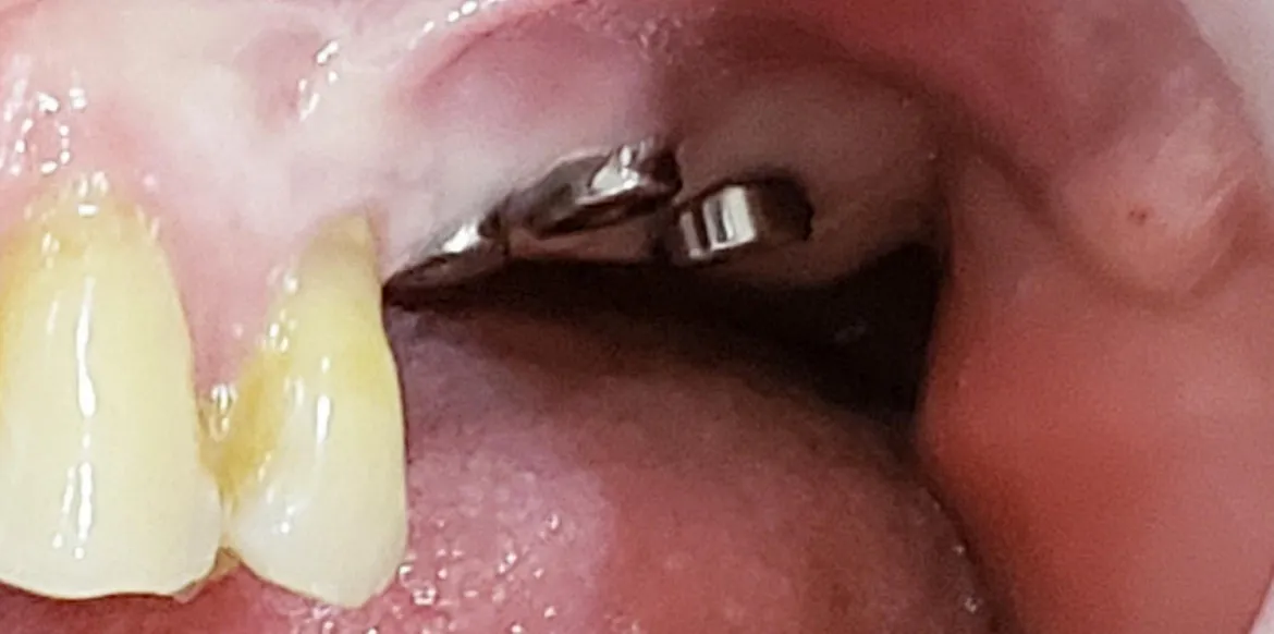 Zona molar sin dientes con implantes colocados en sector posterior