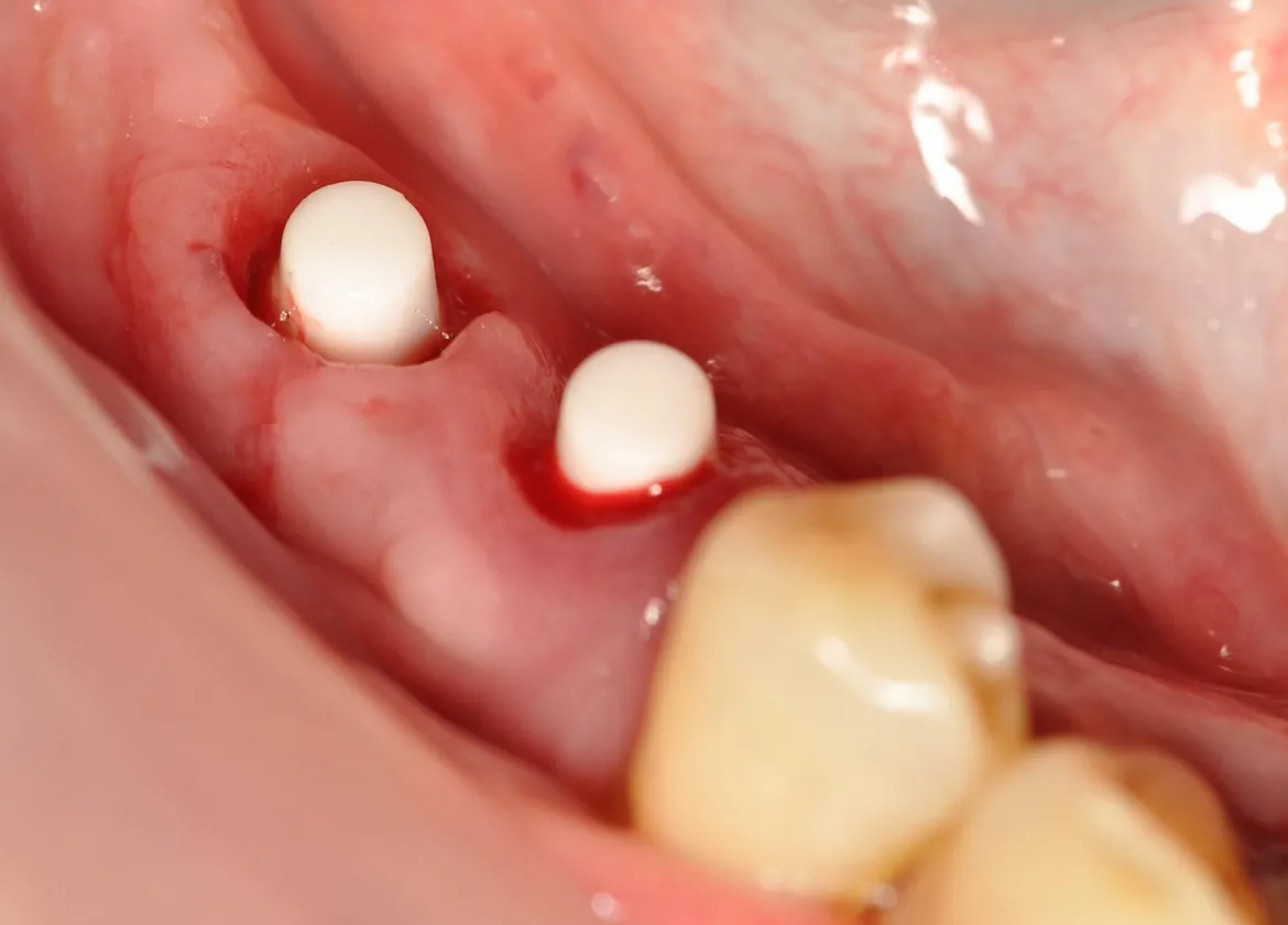 Implantes recién colocados en sector posterior con pilares provisorios